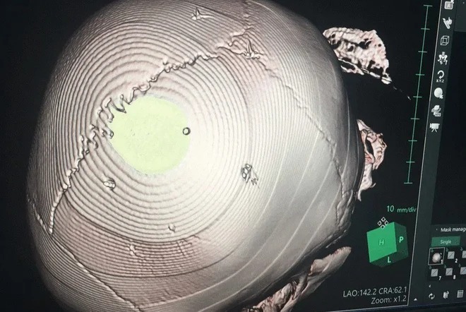 Hình ảnh chụp X-quang hộp sọ của nạn nhân. Ảnh: Bệnh viện cung cấp