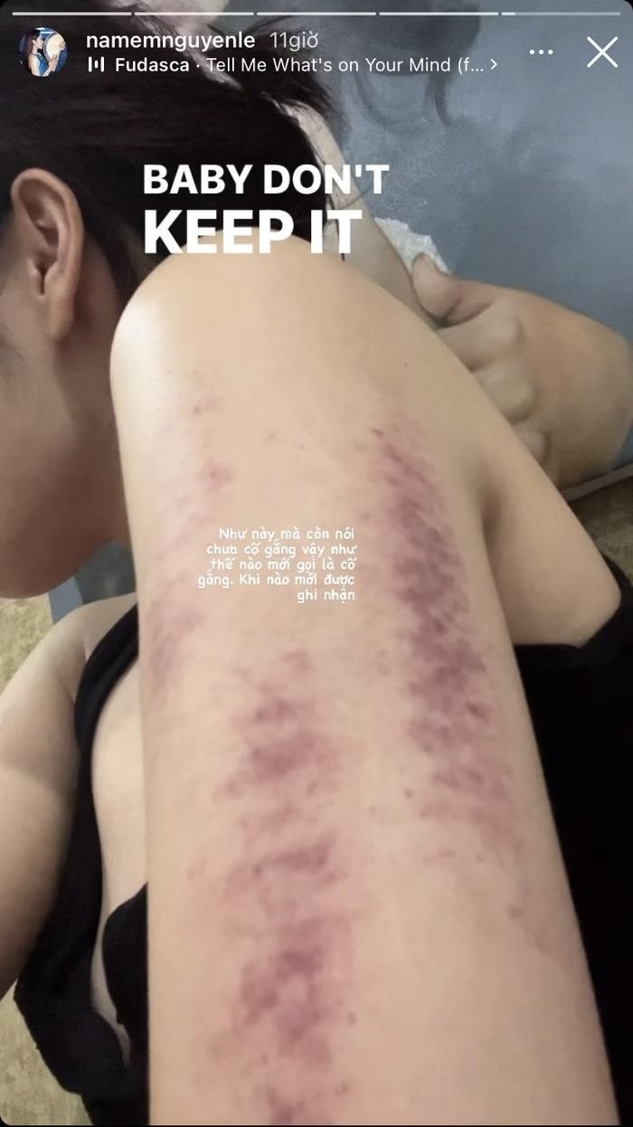 Việc Nam Em để lộ tình trạng sức khỏe báo động đã khiến nhiều khán giả lo lắng. Việc Nam Em để lộ tình trạng sức khỏe báo động đã khiến nhiều khán giả lo lắng.