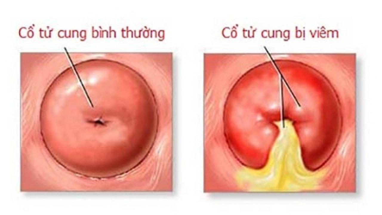 Viêm cổ tử cung và viêm vùng chậu – nỗi lo của những phụ nữ hiện đại 1 Viêm cổ tử cung và viêm vùng chậu – nỗi lo của những phụ nữ hiện đại 1