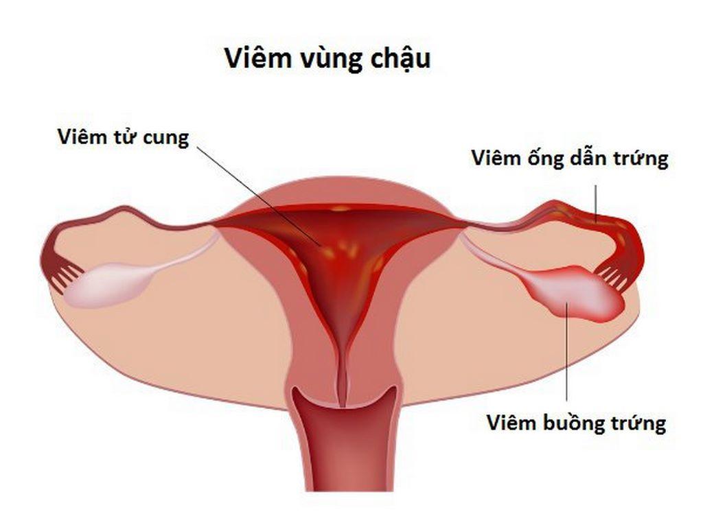 Viêm cổ tử cung và viêm vùng chậu – nỗi lo của những phụ nữ hiện đại 2 Viêm cổ tử cung và viêm vùng chậu – nỗi lo của những phụ nữ hiện đại 2