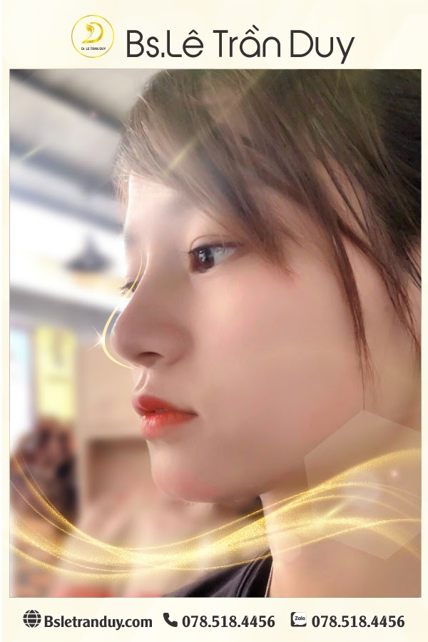 Dáng mũi uốn lượn, mềm mại đẹp tự nhiên được thực hiện ở bác sĩ giỏi Dáng mũi uốn lượn, mềm mại đẹp tự nhiên được thực hiện ở bác sĩ giỏi