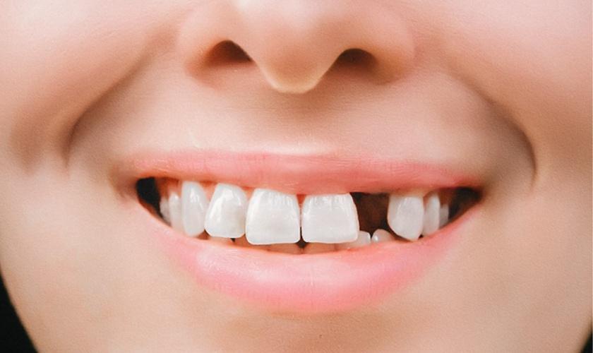 Mất răng gây nên những hậu quả khôn lường