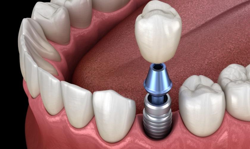 Răng implant mang đến nhiều ưu điểm vượt trội