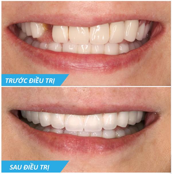 Cấy ghép implant giúp khôi phục thẩm mỹ, chức năng nhai cho những bệnh nhân mất răng Cấy ghép implant giúp khôi phục thẩm mỹ, chức năng nhai cho những bệnh nhân mất răng