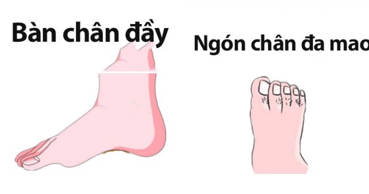 Bàn chân đầy và chân đa mao