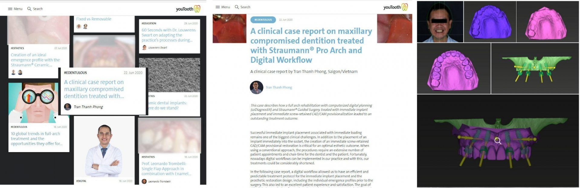 Bài nghiên cứu của Bác sĩ Trần Thanh Phong trên báo Youtooth 