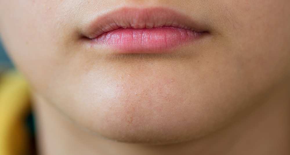 Mụn ẩn có nên nặn không? - ảnh 1