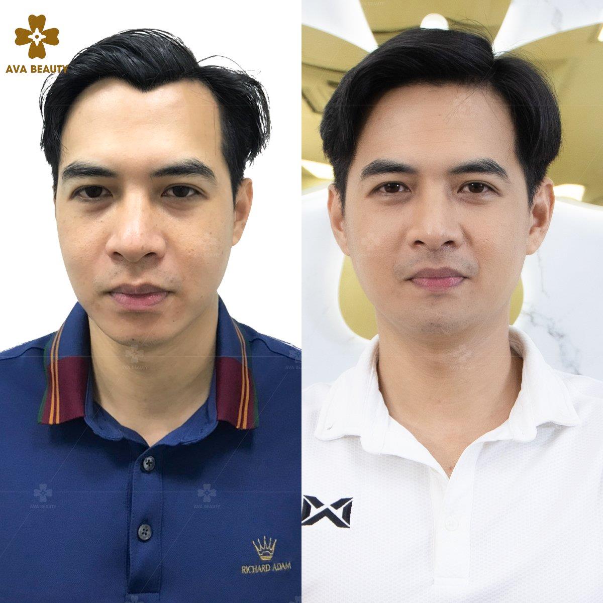 Khắc phục hói chữ M tại Phòng khám da liễu AVA