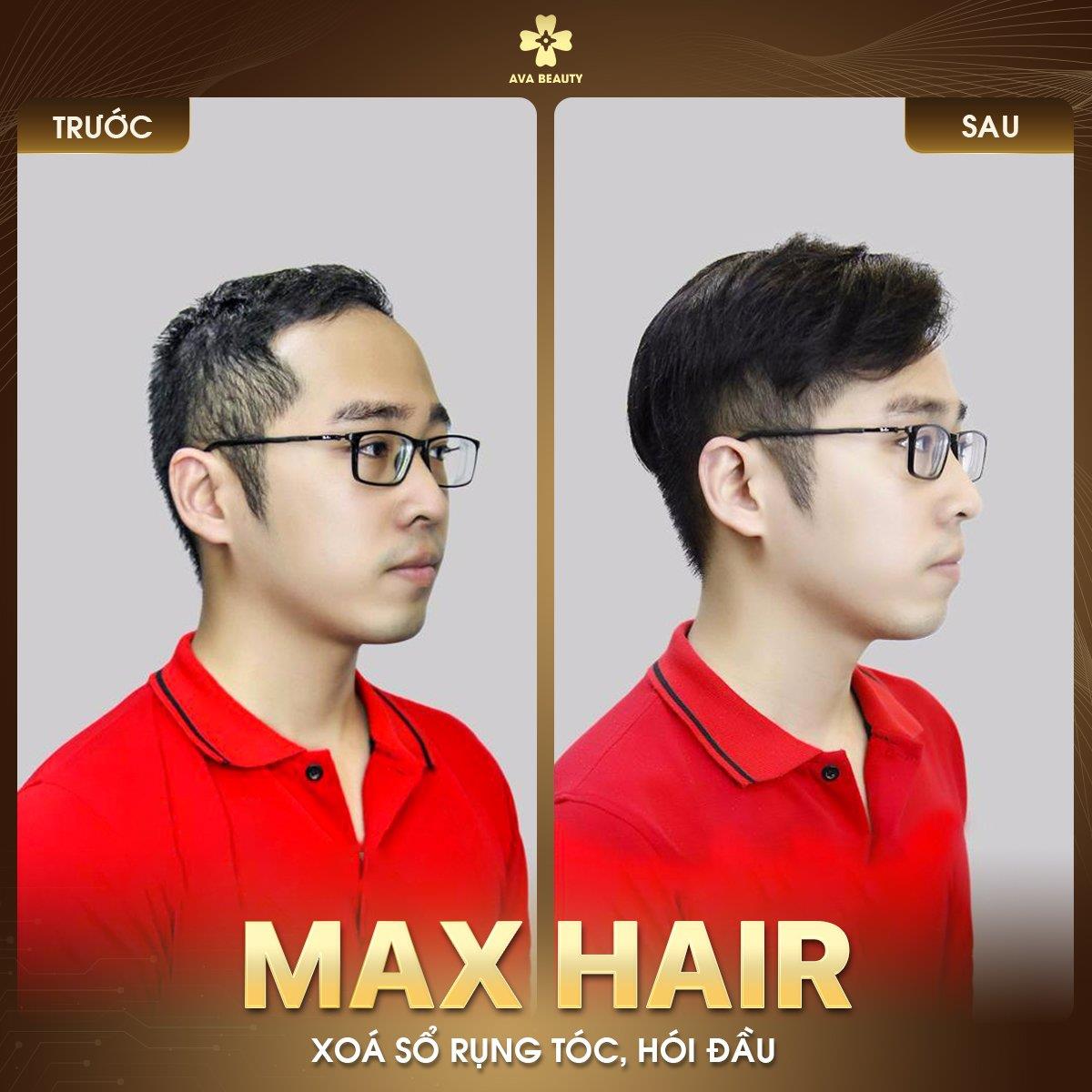 Điều trị hói chữ M tại Phòng khám da liễu AVA