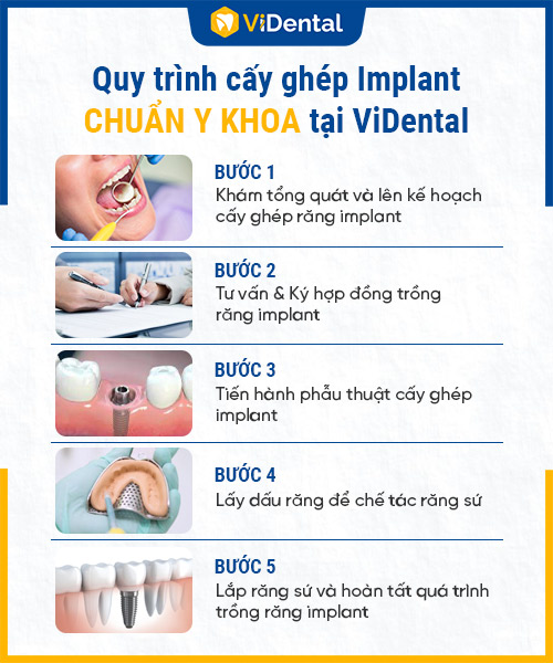 5 Tiêu chuẩn vàng trồng răng Implant không đau, bền đẹp tại ViDental - Ảnh 3 5 Tiêu chuẩn vàng trồng răng Implant không đau, bền đẹp tại ViDental - Ảnh 3