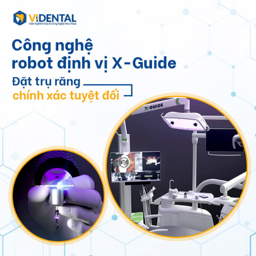 5 Tiêu chuẩn vàng trồng răng Implant không đau, bền đẹp tại ViDental - Ảnh 2 5 Tiêu chuẩn vàng trồng răng Implant không đau, bền đẹp tại ViDental - Ảnh 2