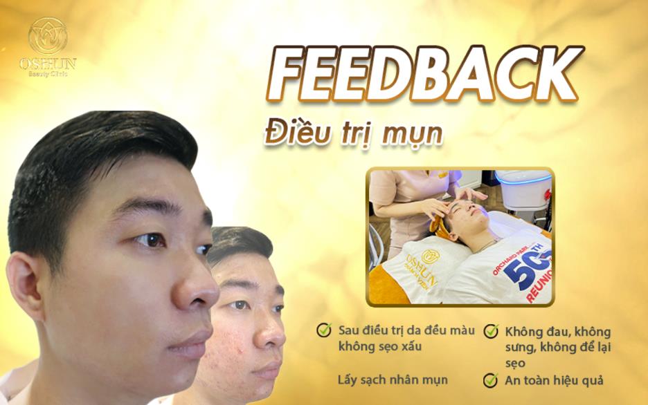 Điều trị mụn chuẩn y Khoa kết hợp công nghệ laser tại Thẩm mỹ viện Oshun Biên Hòa được nhiều khách hàng đánh giá cao.