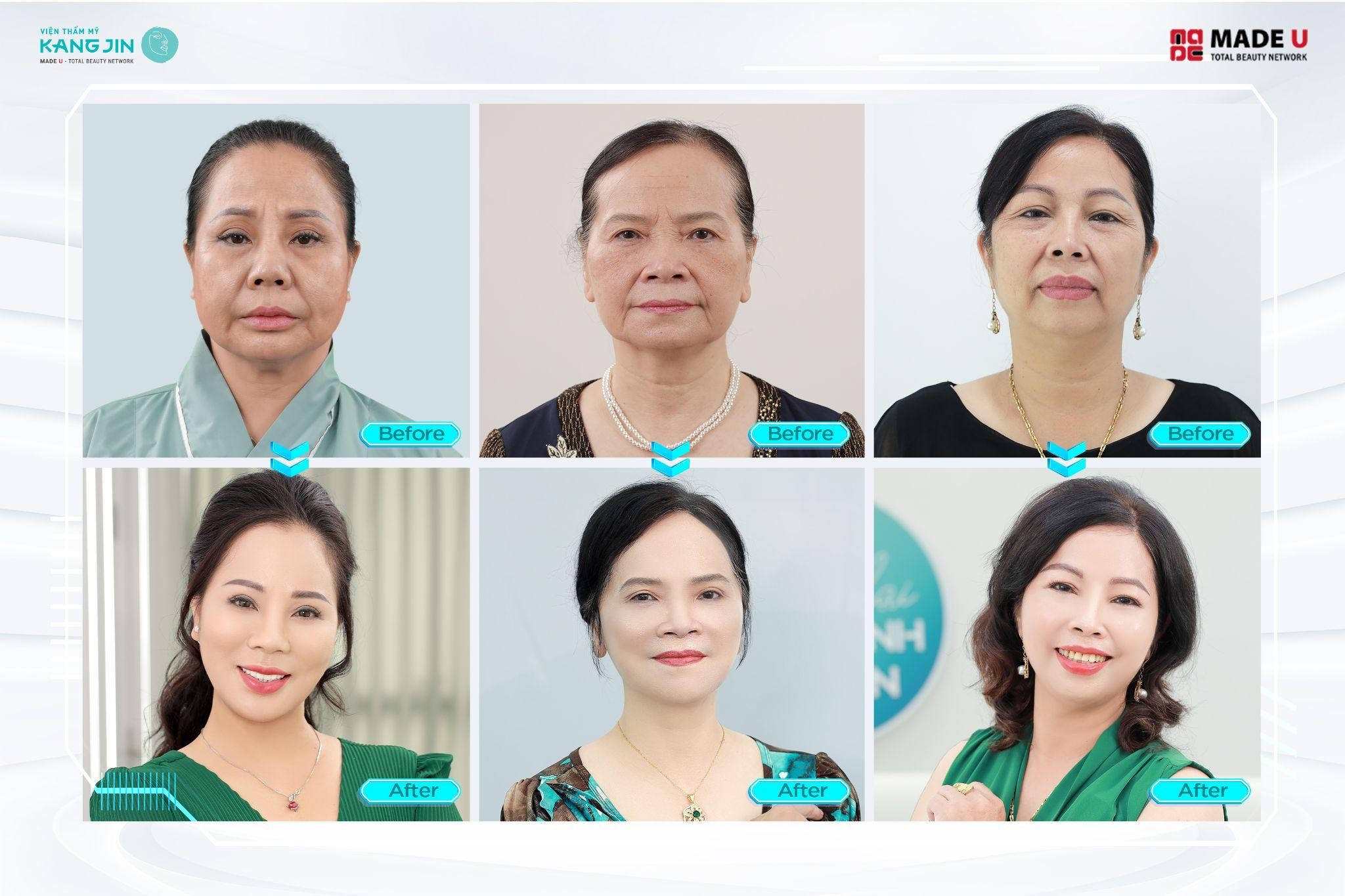 MaxCollagen Diamond Siêu Vi Điểm tác động vào các tầng da làm mờ nếp nhăn, cải thiện chùng xệ, mang lại diện mạo trẻ đẹp như ý. Đặc biệt, Collagen tự thân được tăng sinh mạnh mẽ giúp duy trì  hiệu quả dài lâu