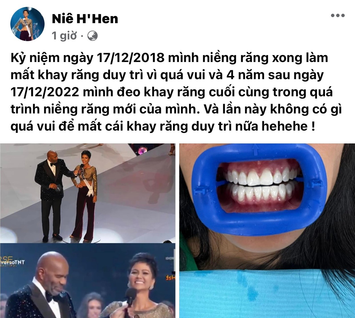 H'Hen Niê vui mừng thông báo được tháo niềng răng sau 4 năm mòn mỏi chờ đợi