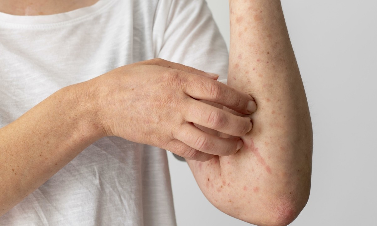 Bài thuốc chữa dị ứng, mề đay, mẩn ngứa từ khế