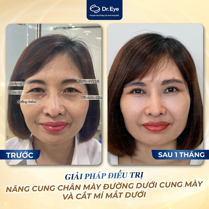 4 Tiêu chí lựa chọn địa chỉ nâng cung chân mày uy tín