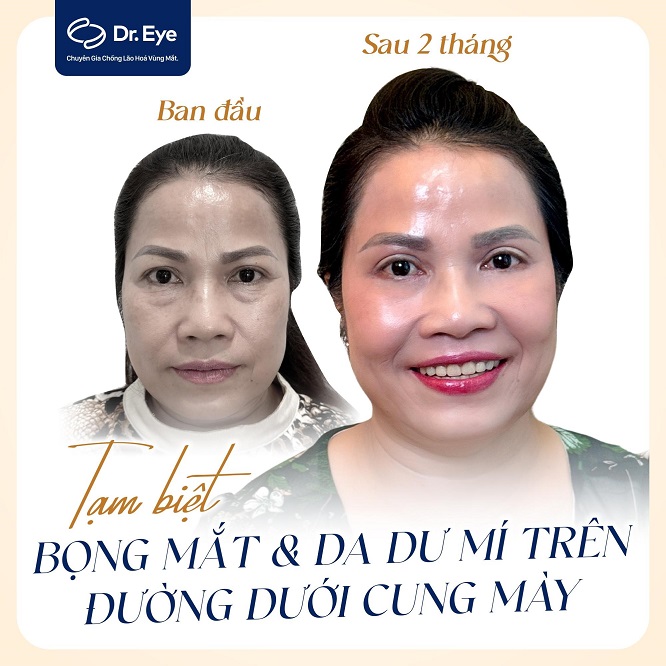 4 Tiêu chí lựa chọn địa chỉ nâng cung chân mày uy tín