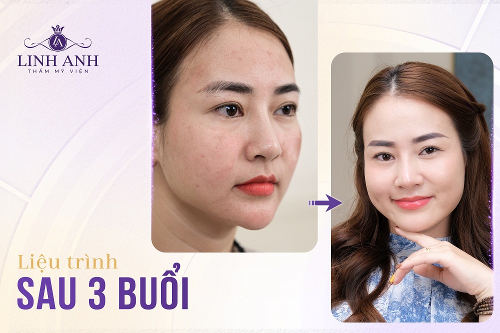 Thẩm mỹ viện Linh Anh: “Hồi sinh” làn da với Cấy collagen tươi - Ảnh 3 Thẩm mỹ viện Linh Anh: “Hồi sinh” làn da với Cấy collagen tươi - Ảnh 3