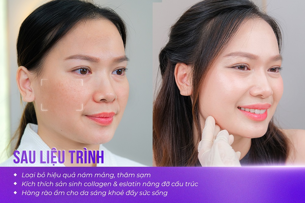Thẩm mỹ viện Linh Anh: “Hồi sinh” làn da với Cấy collagen tươi - Ảnh 2 Thẩm mỹ viện Linh Anh: “Hồi sinh” làn da với Cấy collagen tươi - Ảnh 2