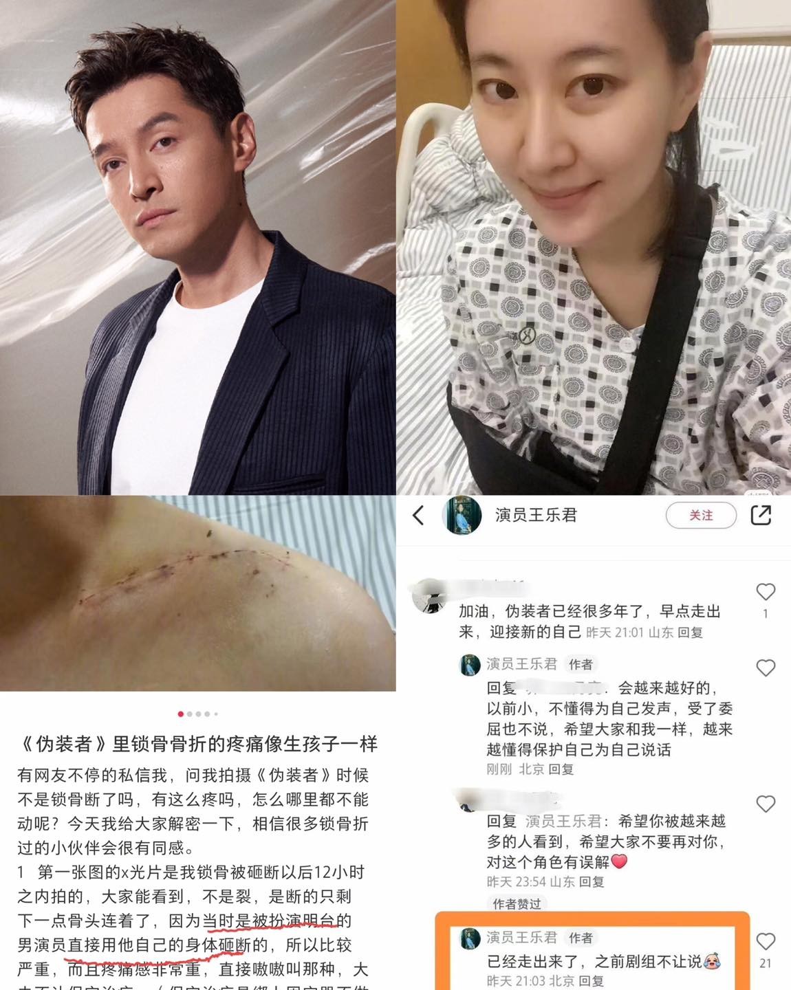 No.1 Hot search Weibo: Vương Lạc Quân ám chỉ bị Hồ Ca làm gãy xương quai xanh khi quay bộ phim 'Kẻ Ngụy Trang'. Khi quay 1 cảnh phim, cô bị Hồ Ca đè lên dẫn tới gãy xương quai xanh và phải gắn 7 chiếc đinh để cố định. Đoàn làm phim bắt cô phải xuất viện chỉ sau 3 tuần để quay tiếp khiến sức khỏe bị ảnh hưởng nghiêm trọng.