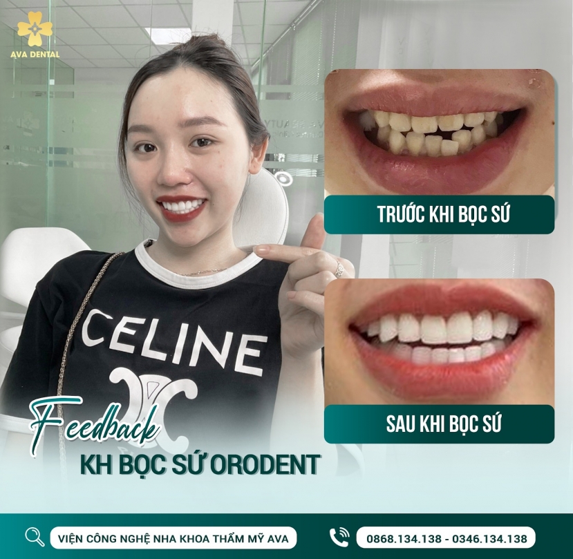 Công nghệ bọc sứ Orodent cực đỉnh Công nghệ bọc sứ Orodent cực đỉnh