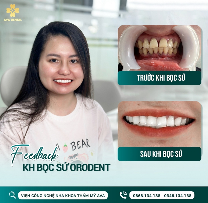 Răng sứ Orodent mang lại hiệu quả thẩm mỹ cao cho khách hàng Răng sứ Orodent mang lại hiệu quả thẩm mỹ cao cho khách hàng