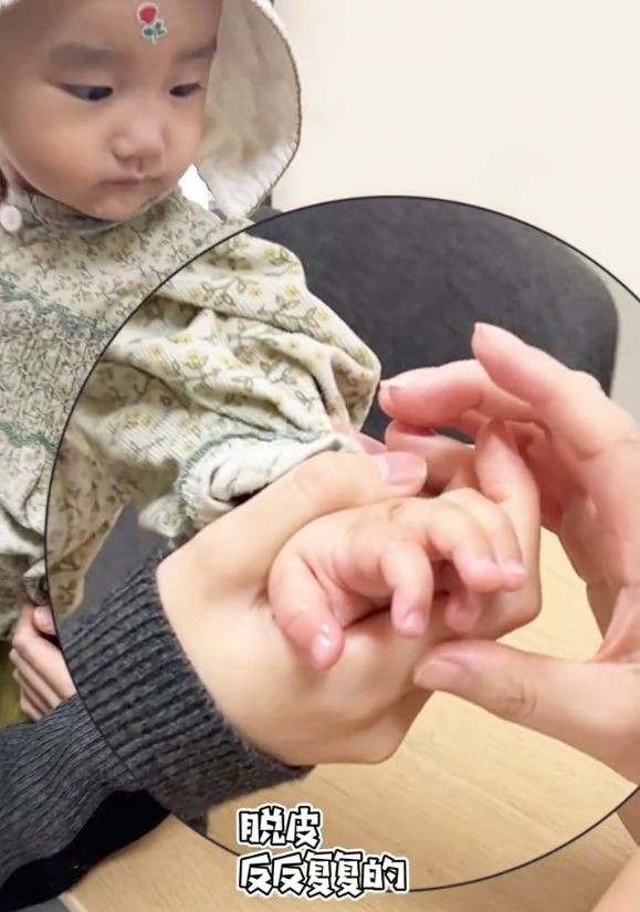 Con gái thứ 2 của Lý Á Bằng bị bong tróc da tay trong một thời gian dài, bôi thuốc không khỏi. Con gái thứ 2 của Lý Á Bằng bị bong tróc da tay trong một thời gian dài, bôi thuốc không khỏi.