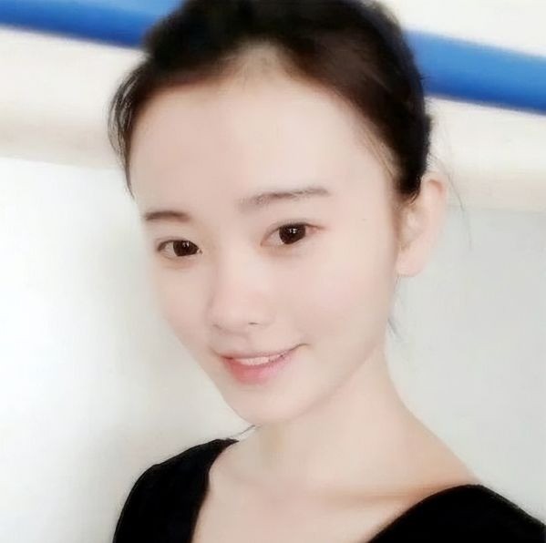 Mái tóc mỏng, thưa và hói của Cúc Tịnh Y trước khi nổi tiếng. Mái tóc mỏng, thưa và hói của Cúc Tịnh Y trước khi nổi tiếng.