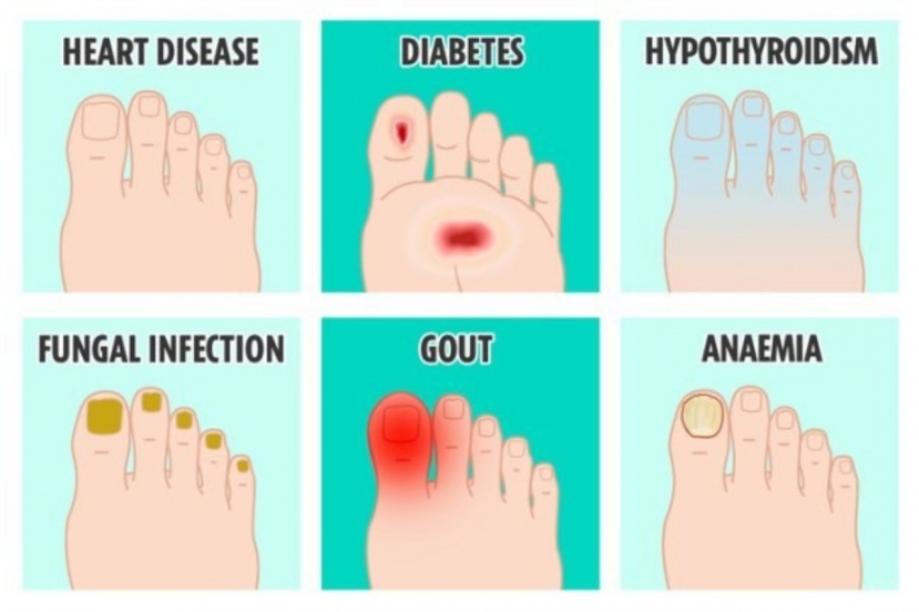 Từ trái qua phải, từ trên xuống dưới là biểu hiện của các bệnh: bệnh tim, tiểu đường, suy giáp, nhiễm nấm, bệnh gout, thiếu máu. Ảnh: The Sun Từ trái qua phải, từ trên xuống dưới là biểu hiện của các bệnh: bệnh tim, tiểu đường, suy giáp, nhiễm nấm, bệnh gout, thiếu máu. Ảnh: The Sun