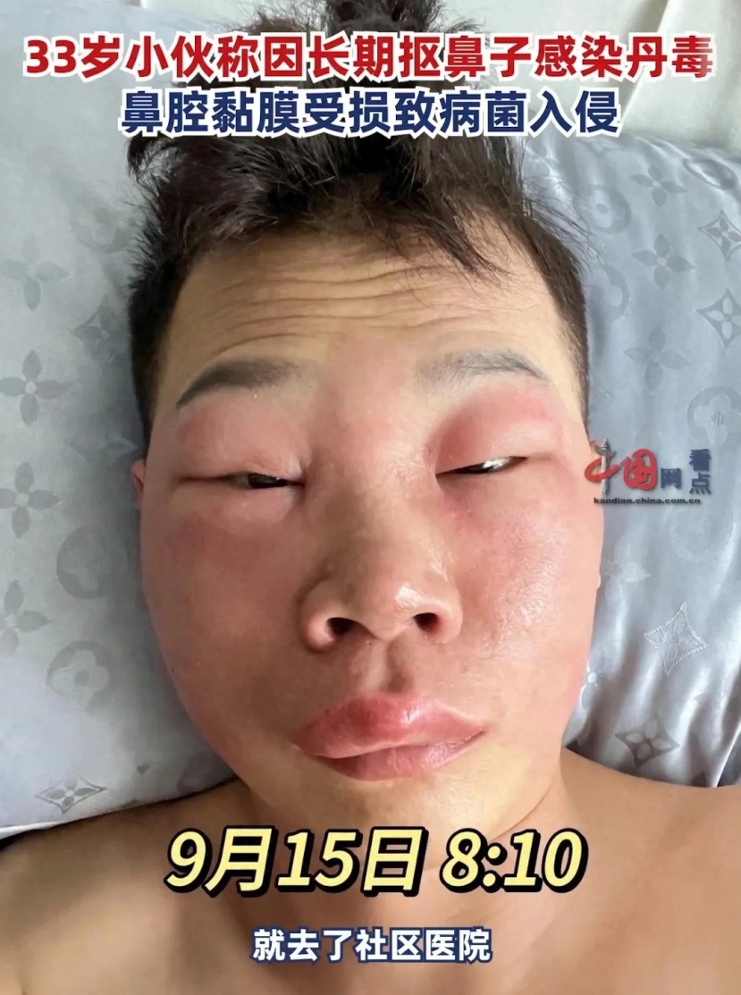 Ban đầu, bệnh viện chẩn đoán nhầm anh ta bị viêm amidan. Ảnh: Internet Ban đầu, bệnh viện chẩn đoán nhầm anh ta bị viêm amidan. Ảnh: Internet