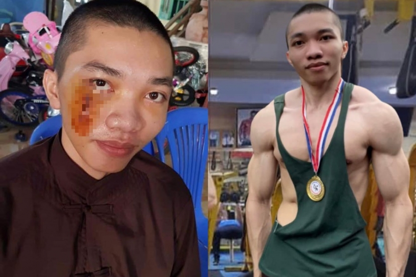 2 năm qua, Nhị Nguyên đến vô số thẩm mỹ viện để tìm cách chữa sẹo, tuy nhiên theo đánh giá của bác sĩ, khuyết điểm này chỉ chữa được 80% 2 năm qua, Nhị Nguyên đến vô số thẩm mỹ viện để tìm cách chữa sẹo, tuy nhiên theo đánh giá của bác sĩ, khuyết điểm này chỉ chữa được 80%